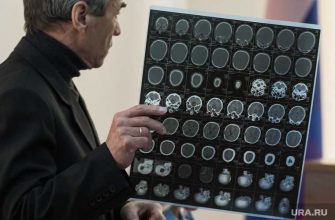 признаки бессимптомного инсульта