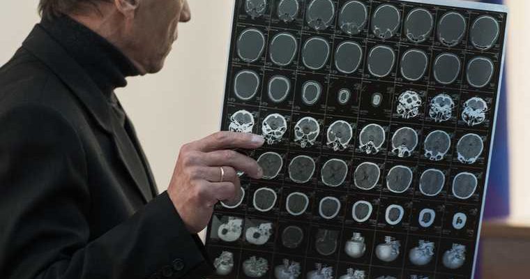 признаки бессимптомного инсульта